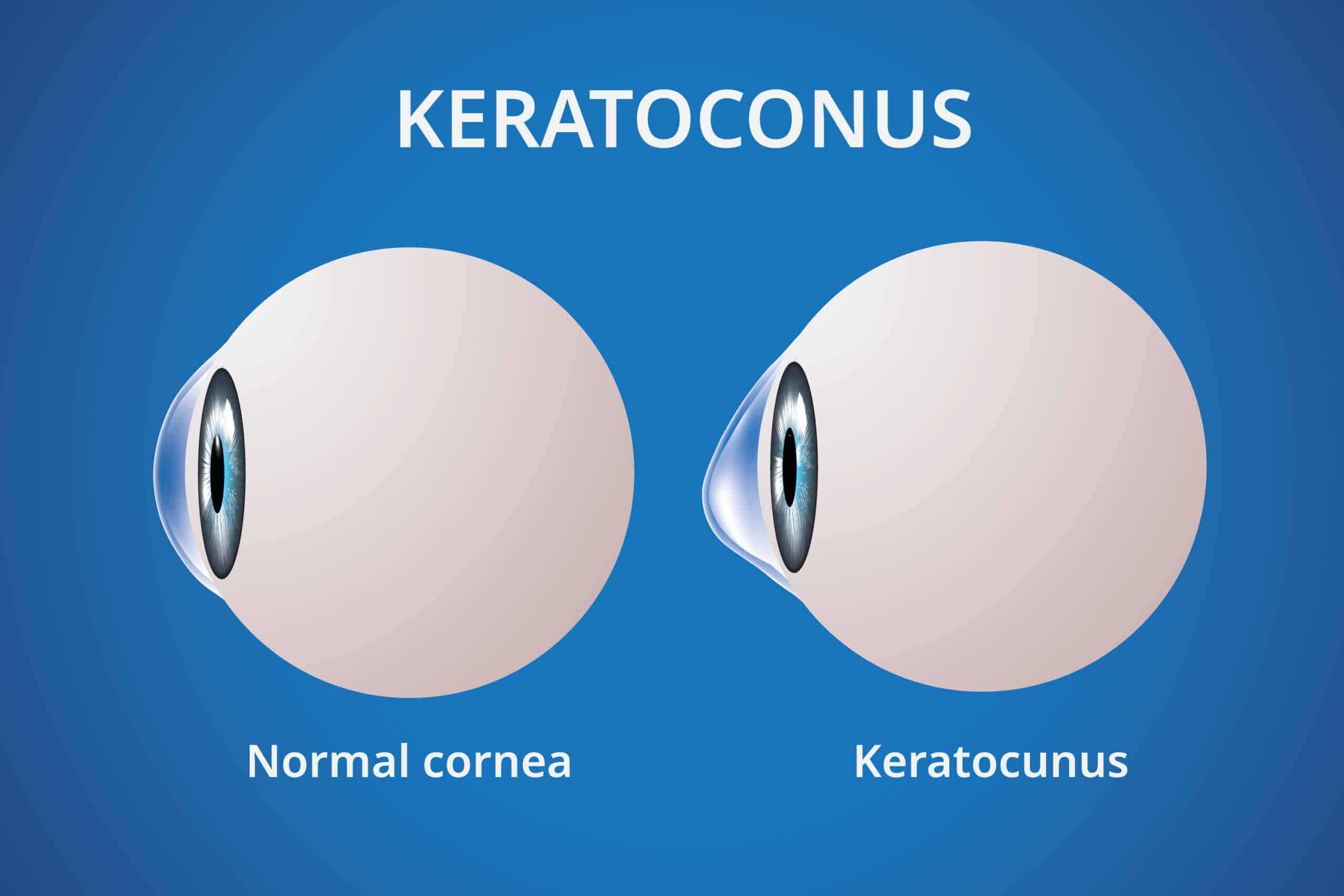 Différence entre la cornée d'un oeil normal et d'un kératocône