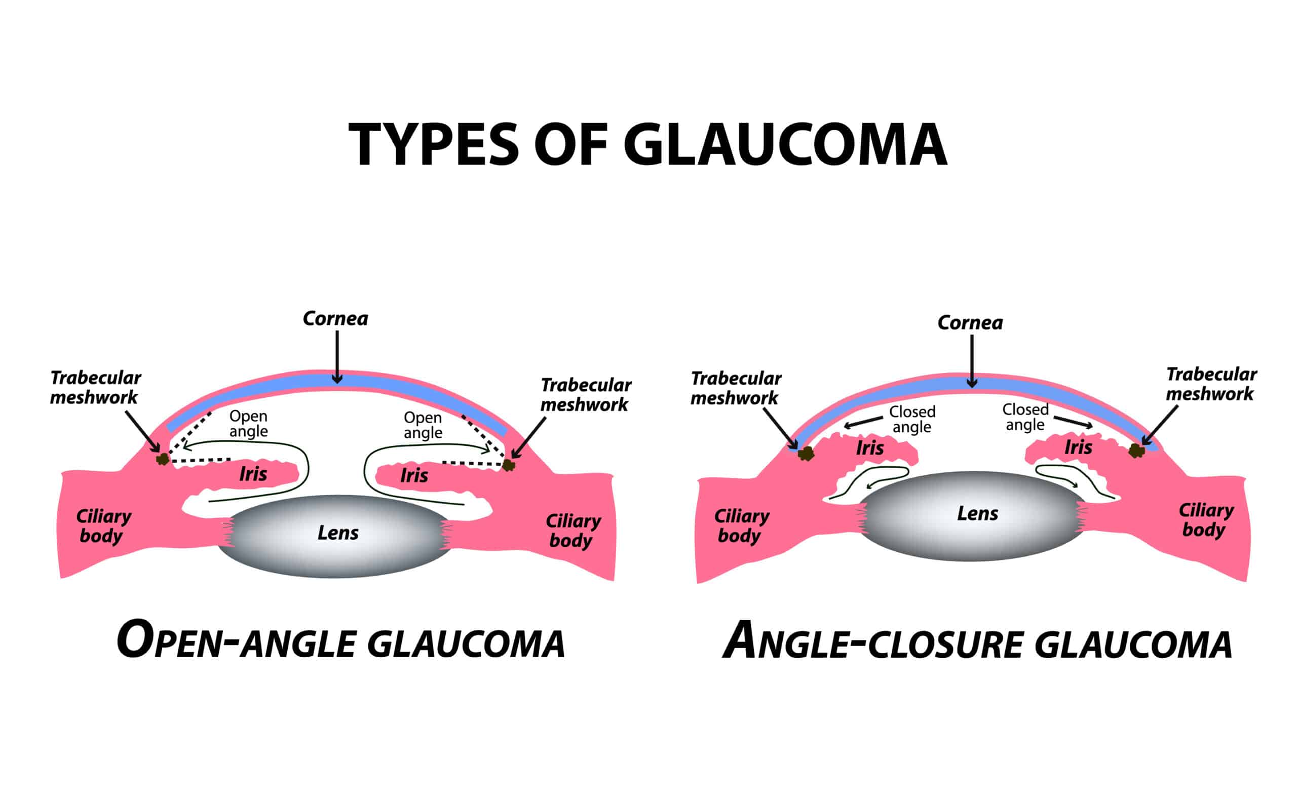 Types de glaucome à l'oeil